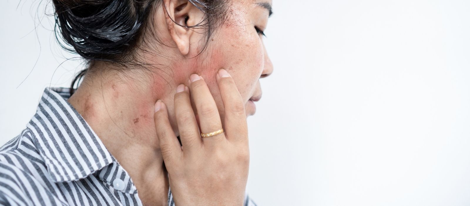 cortisol effects on skin and hair