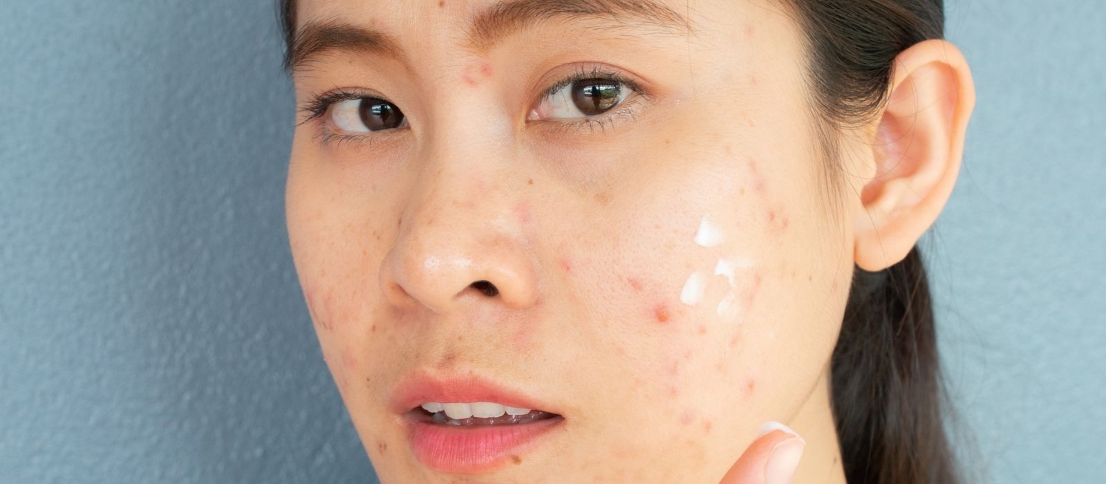 acne breakout skin close up treatment