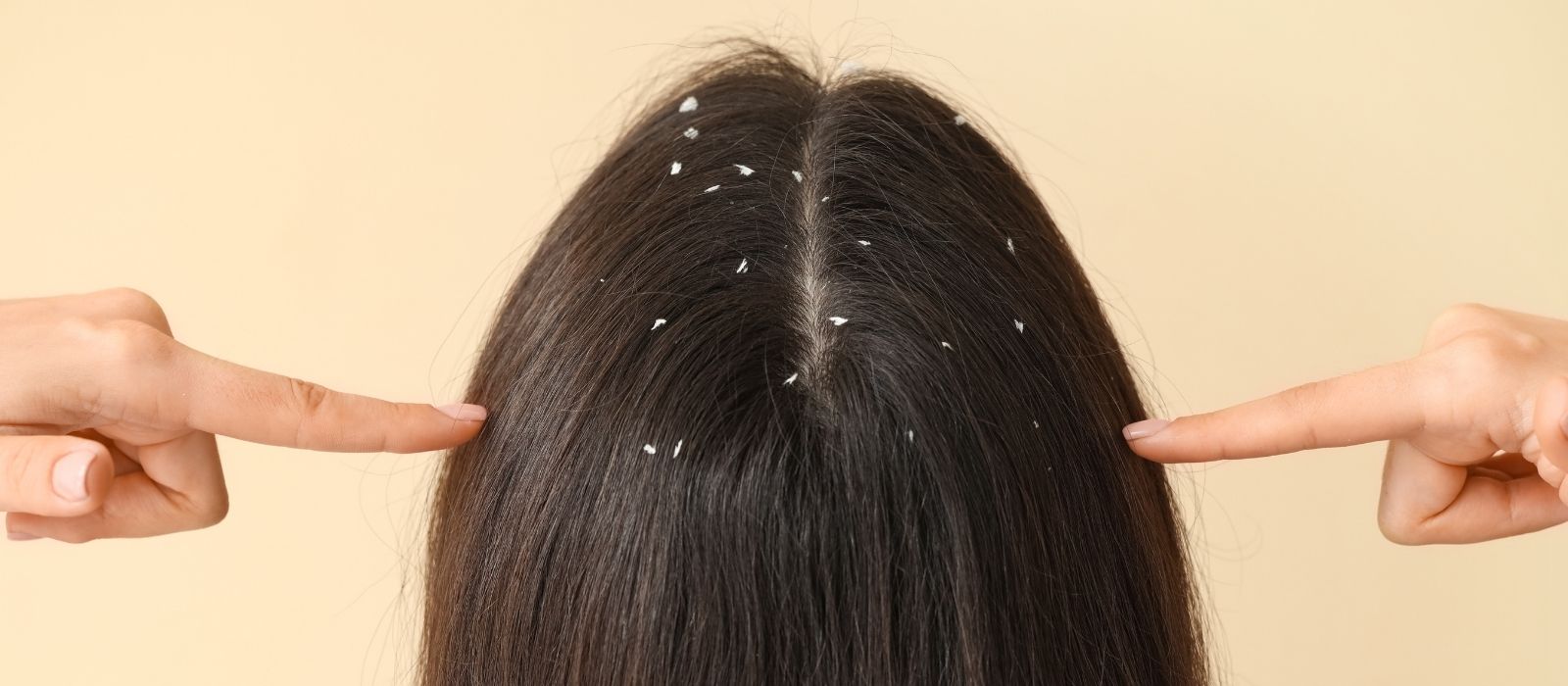 What Are These Bumps and Flakes on My Scalp? How to Identify and Treat Common Scalp Problems