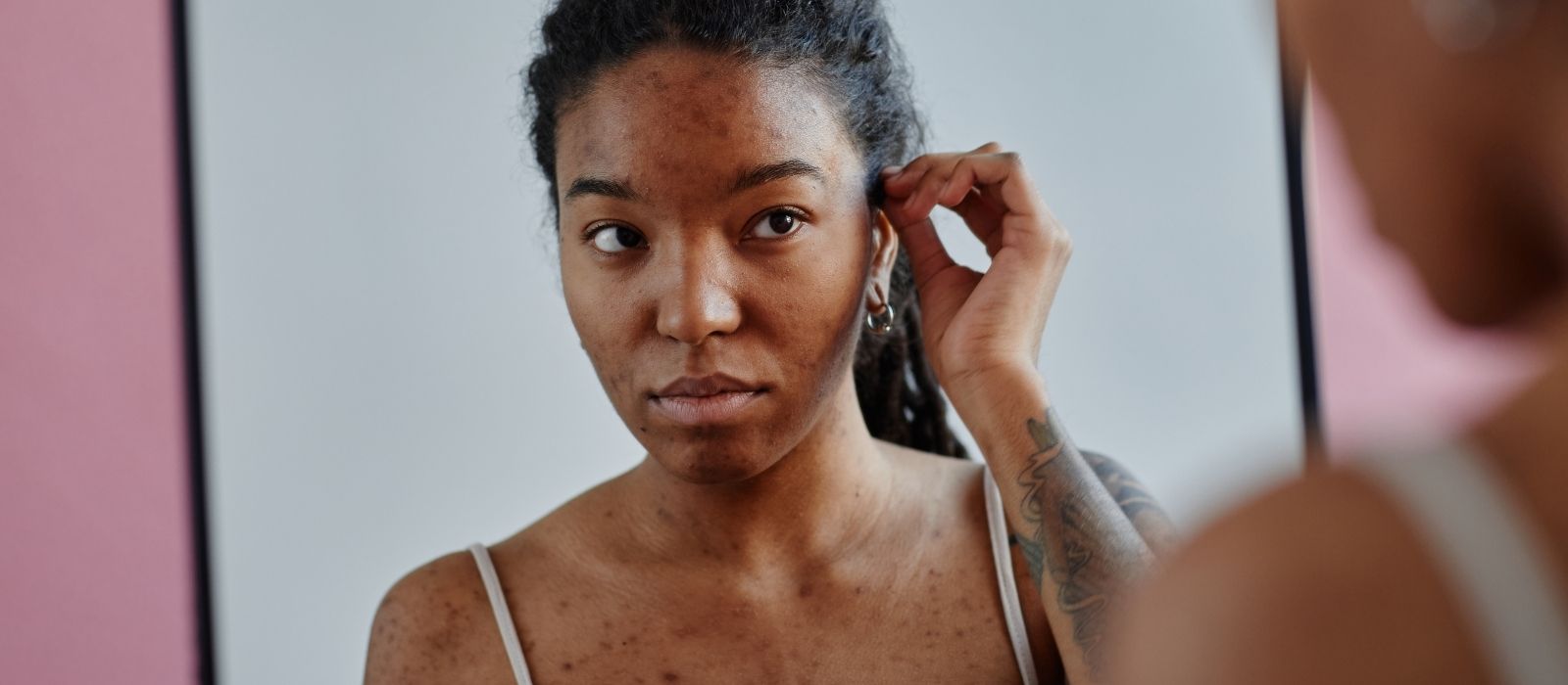 What Is Cortisol Face — Is It Real and Can You Fix It